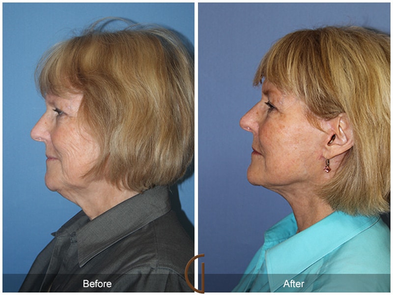 Facelift Palm Springs CA Image