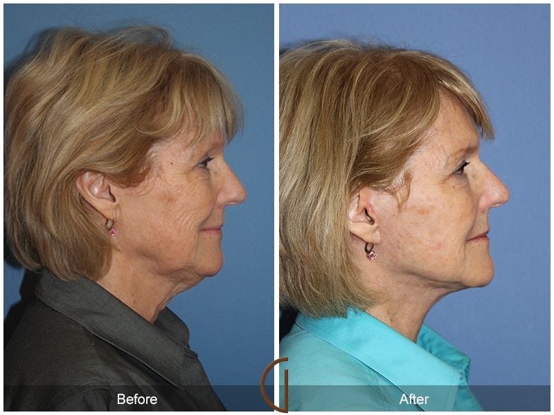 Facelift Palm Springs CA Image