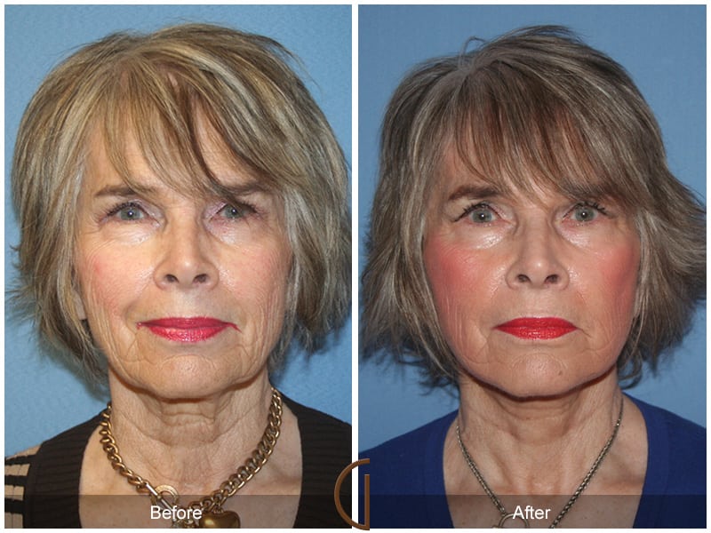 Facelift Newport Beach 211 Image