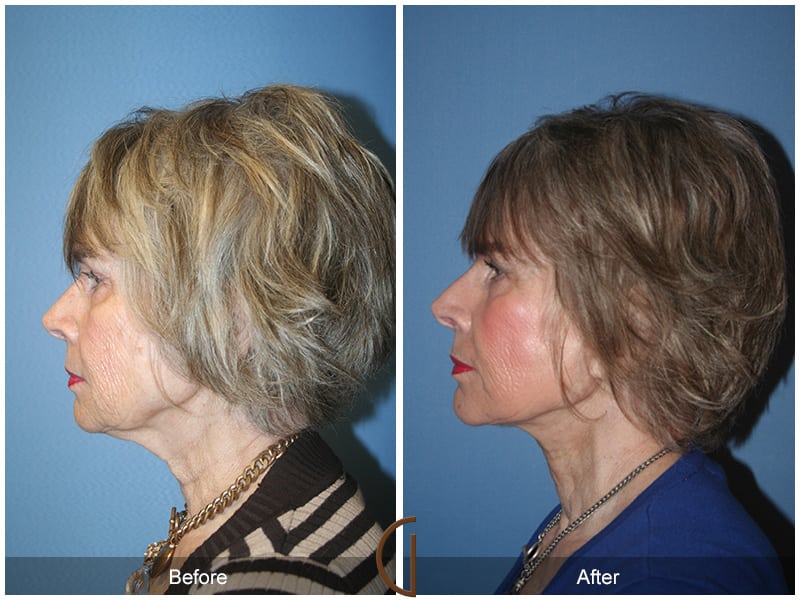 Facelift Newport Beach 211 Image
