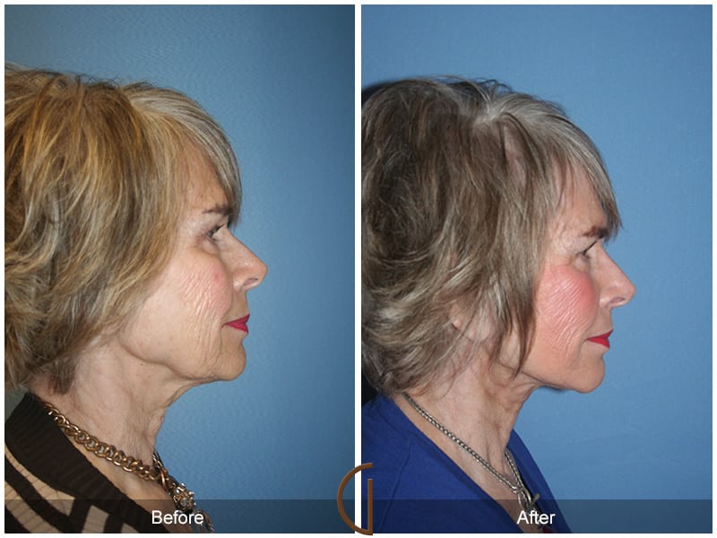 Facelift Newport Beach 211 Image