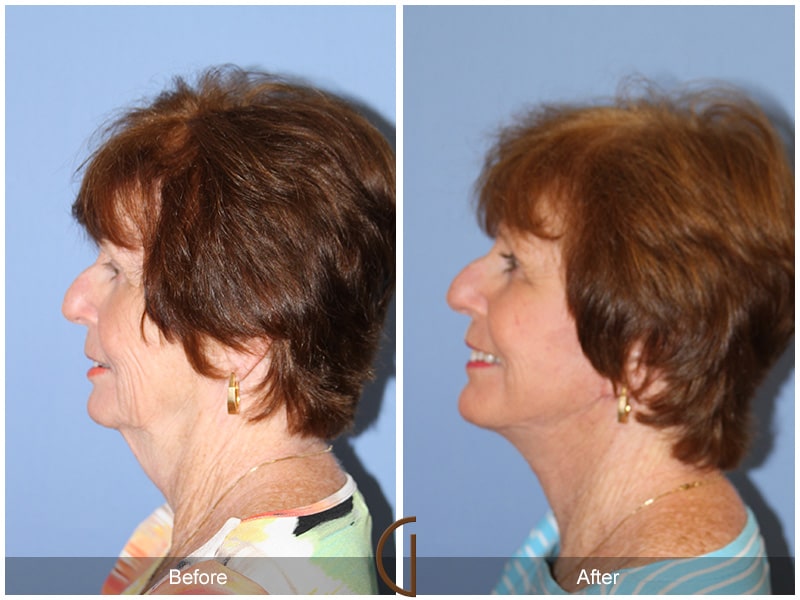 Facelift Newport Beach 212 Image