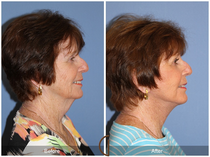 Facelift Newport Beach 212 Image