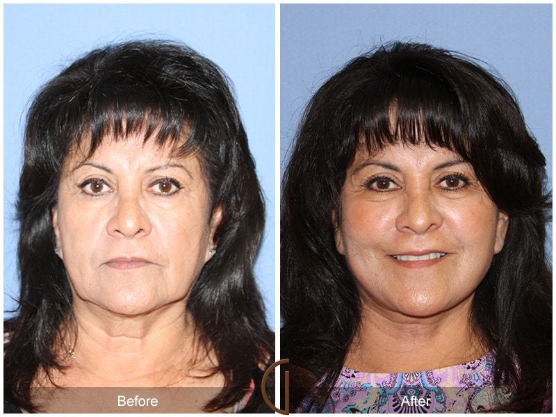Facelift Newport Beach 213 Image