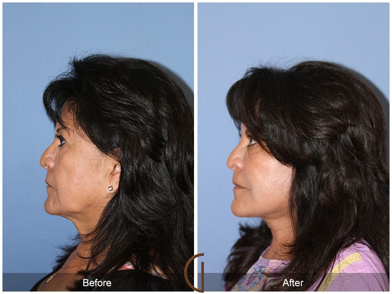 Facelift Newport Beach 213 Image