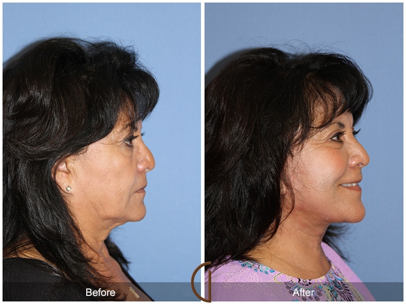 Facelift Newport Beach 213 Image