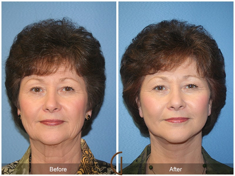 Facelift West Covina CA 91 Image
