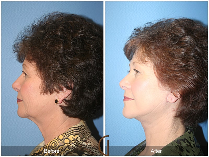 Facelift West Covina CA 91 Image