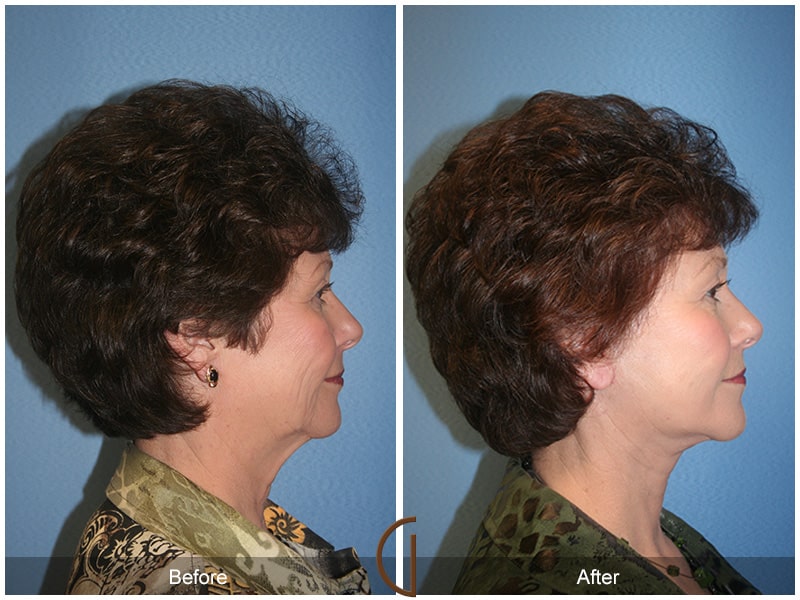 Facelift West Covina CA 91 Image