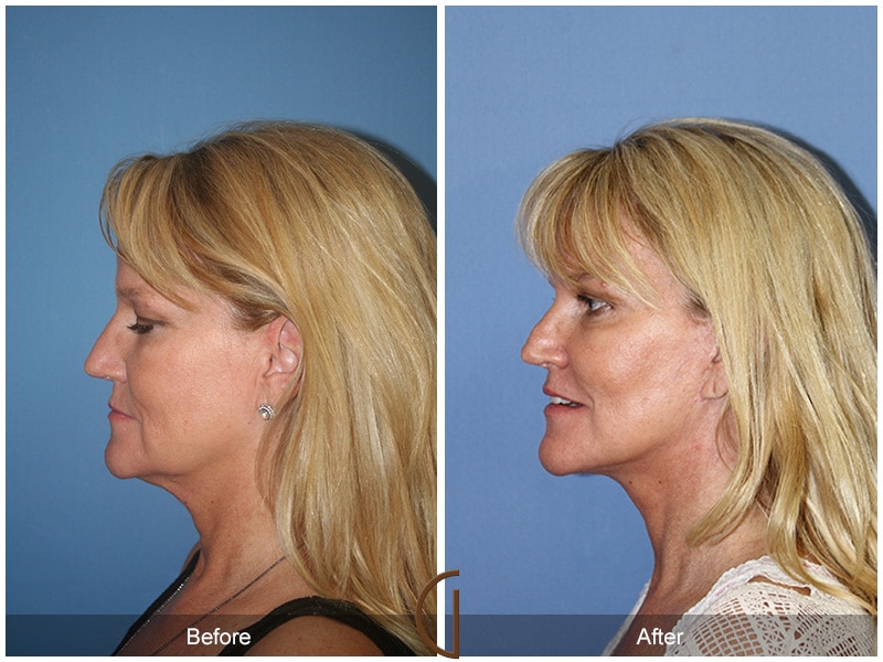 Facelift San Diego CA 99 Image