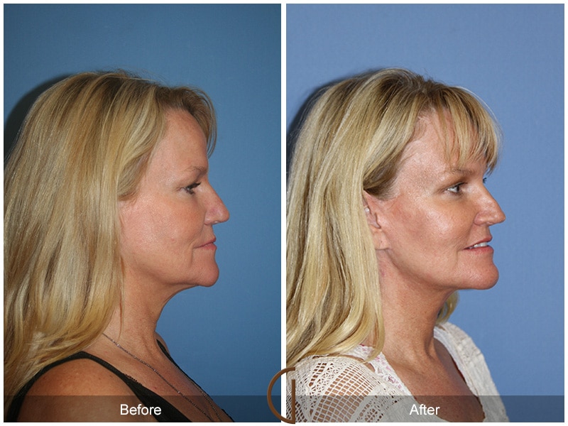 Facelift San Diego CA 99 Image
