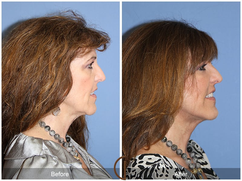 Facial Fat Grafting Brea CA 14 Image