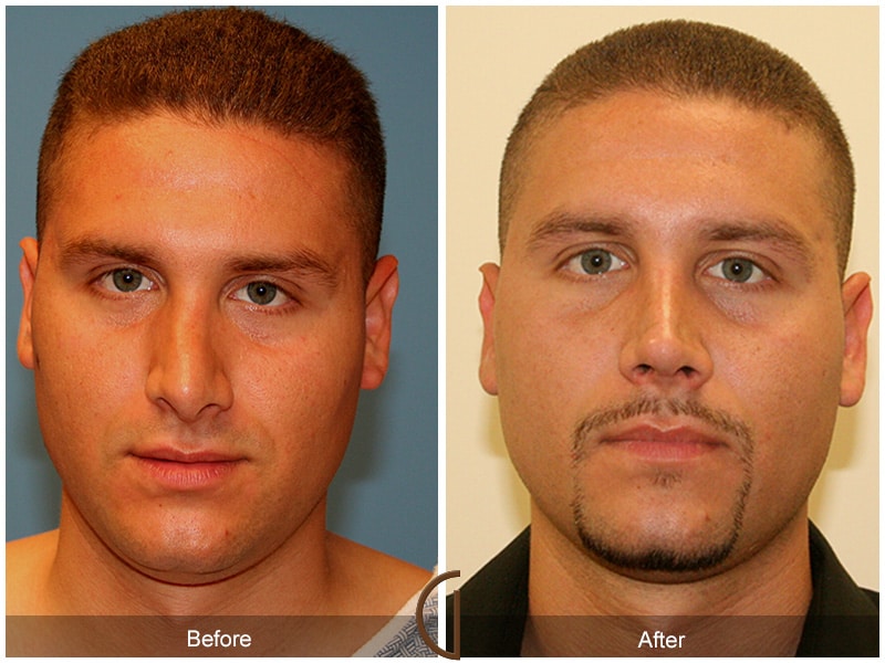 Male Rhinoplasty Orange County CA 2 Image