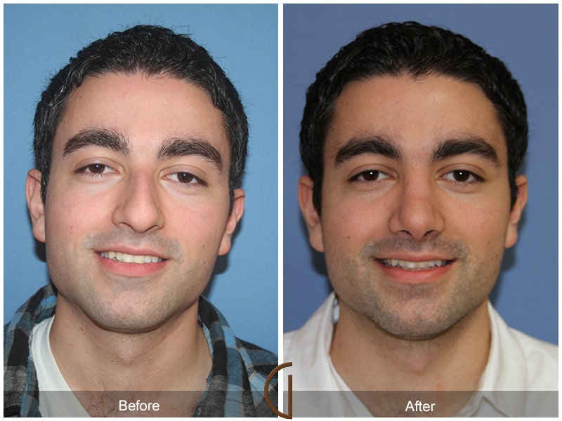 Male Rhinoplasty Ladera Ranch CA 58 Image