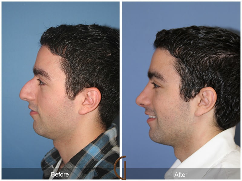 Male Rhinoplasty Ladera Ranch CA 58 Image