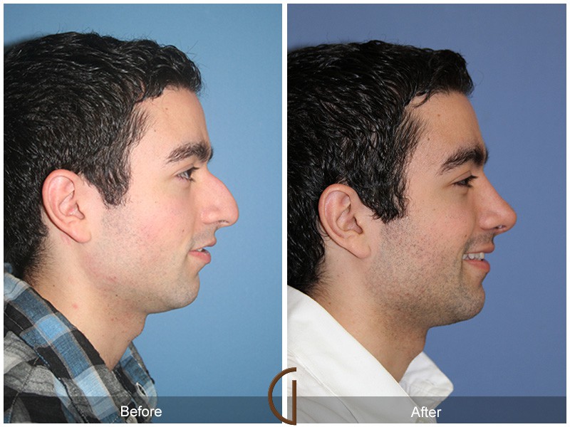 Male Rhinoplasty Ladera Ranch CA 58 Image