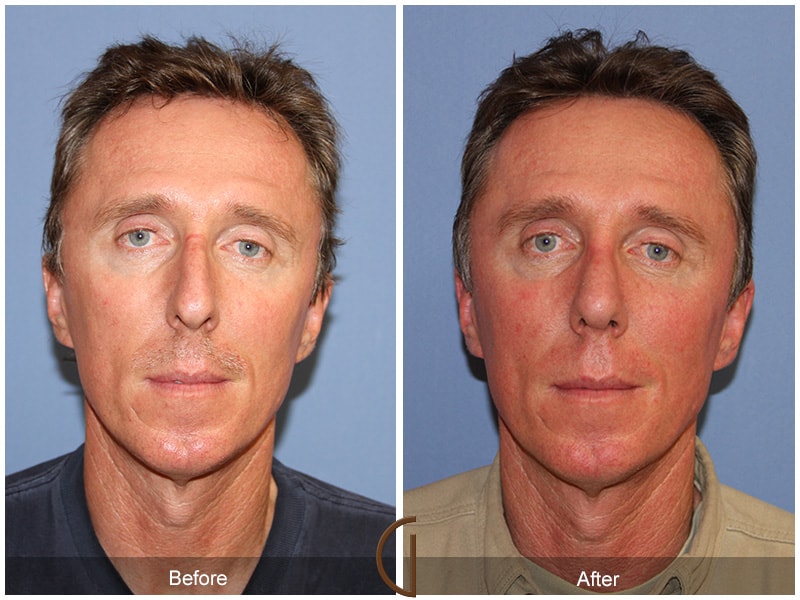 Male Rhinoplasty North Tustin CA 59 Image