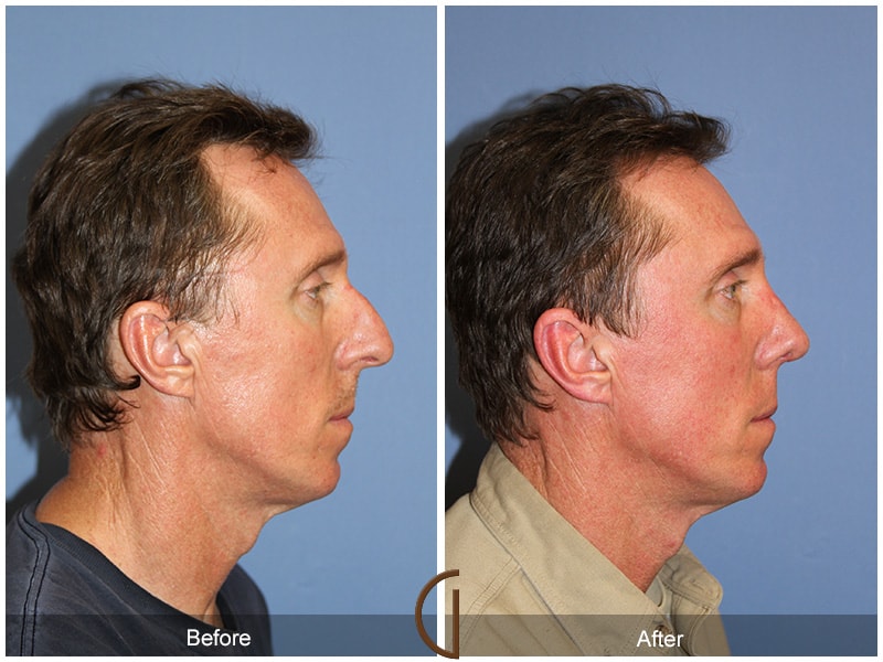 Male Rhinoplasty North Tustin CA 59 Image