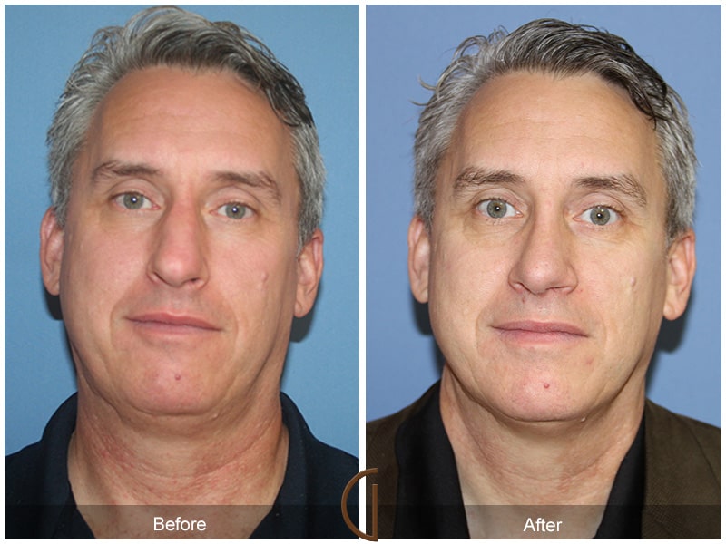 Male Rhinoplasty Las Flores CA 62 Image