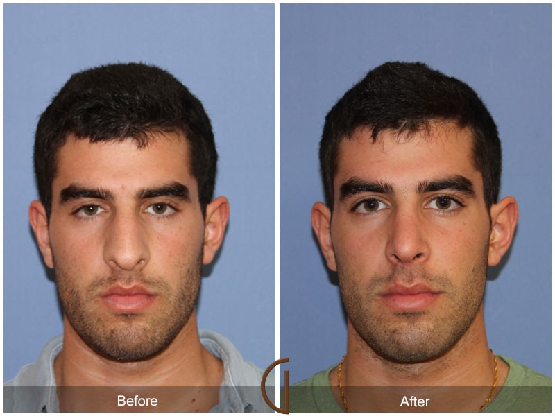 Male Rhinoplasty Yorba Linda CA 63 Image