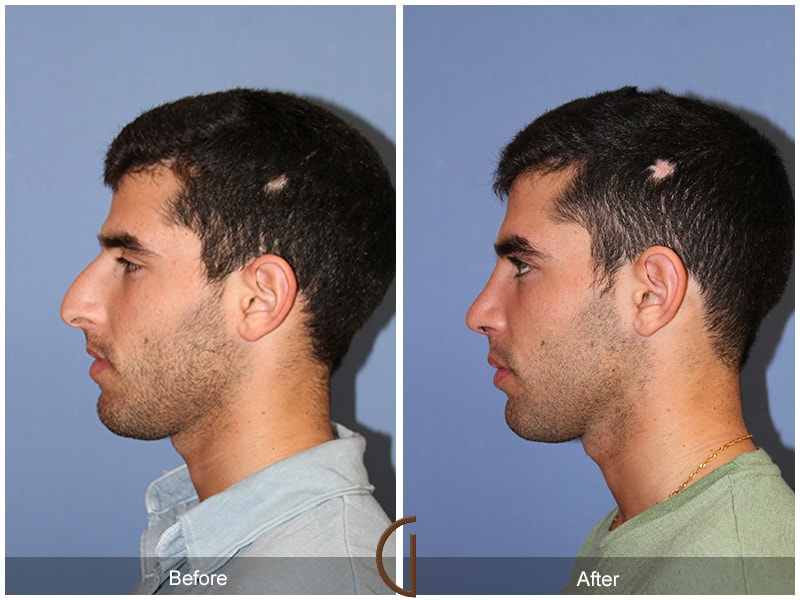 Male Rhinoplasty Yorba Linda CA 63 Image