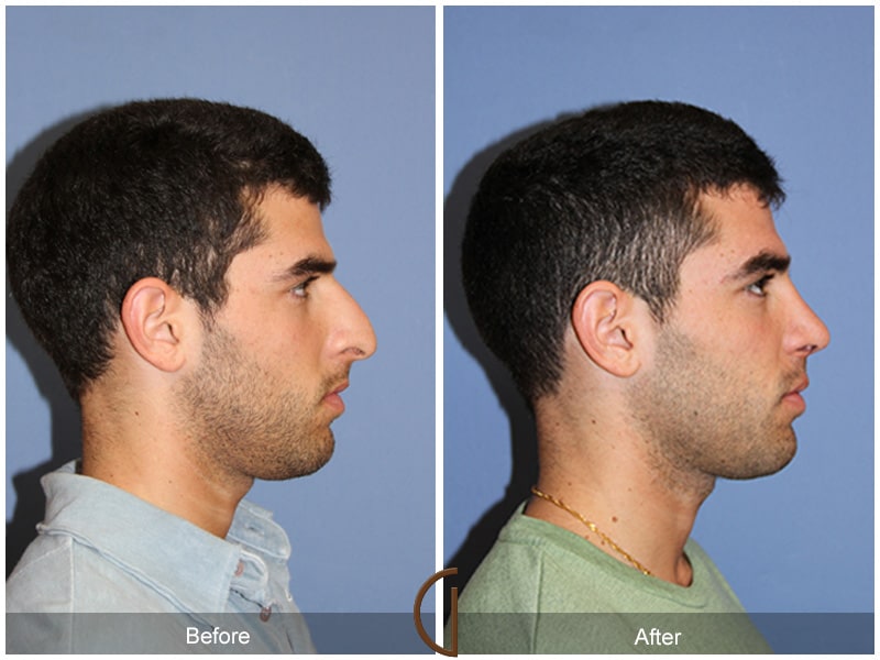 Male Rhinoplasty Yorba Linda CA 63 Image
