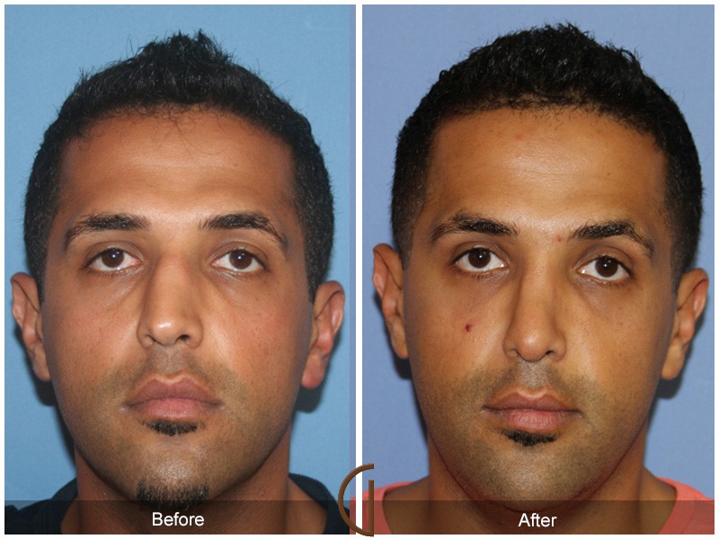 Male Rhinoplasty Rossmoor CA 73 Image