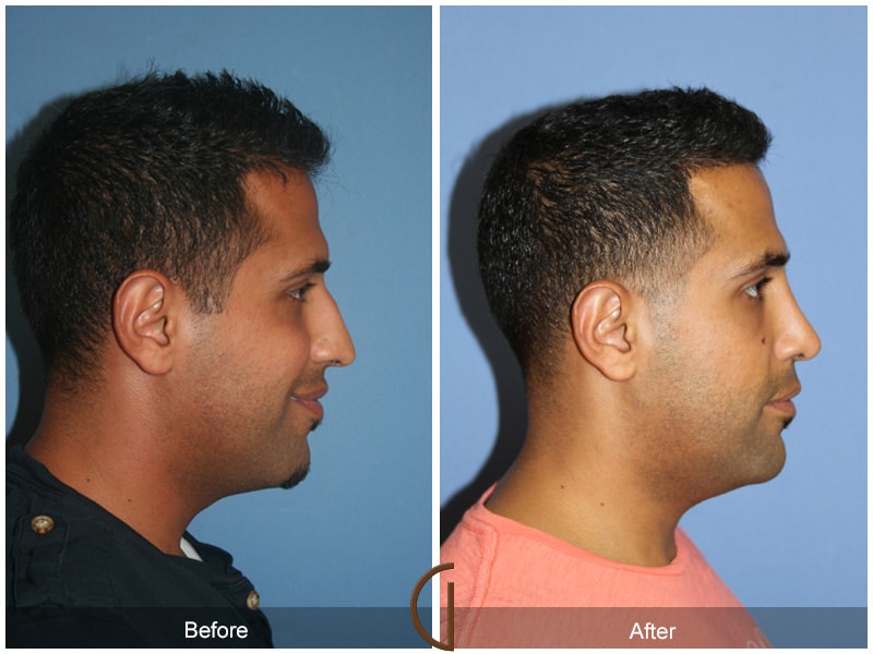 Male Rhinoplasty Rossmoor CA 73 Image