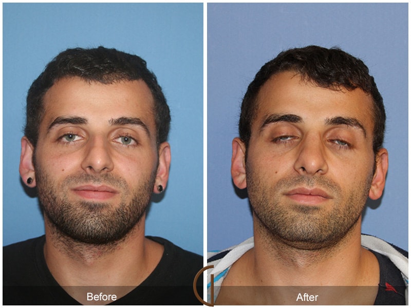 Male Rhinoplasty Newport Beach CA 78 Image