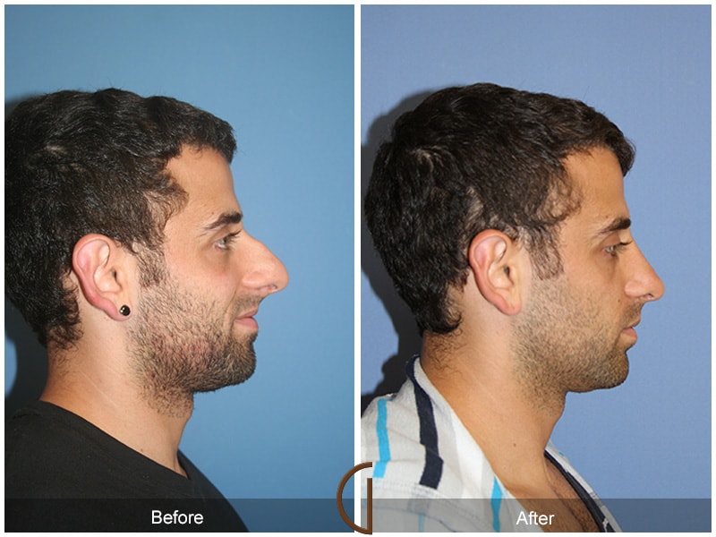 Male Rhinoplasty Newport Beach CA 78 Image
