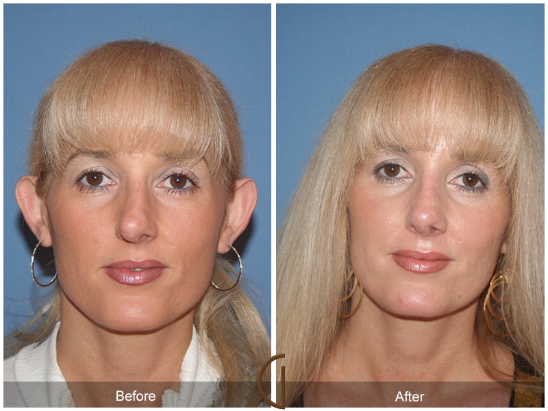 Rhinoplasty North Tustin CA 38 Image