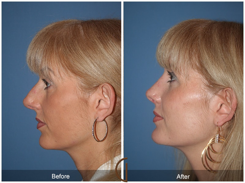 Rhinoplasty North Tustin CA 38 Image