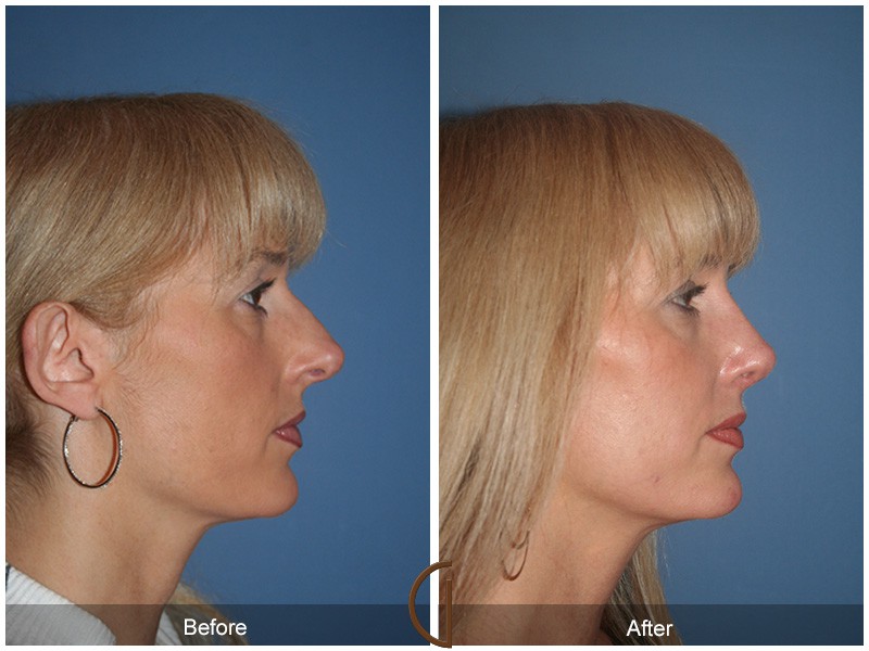 Rhinoplasty North Tustin CA 38 Image