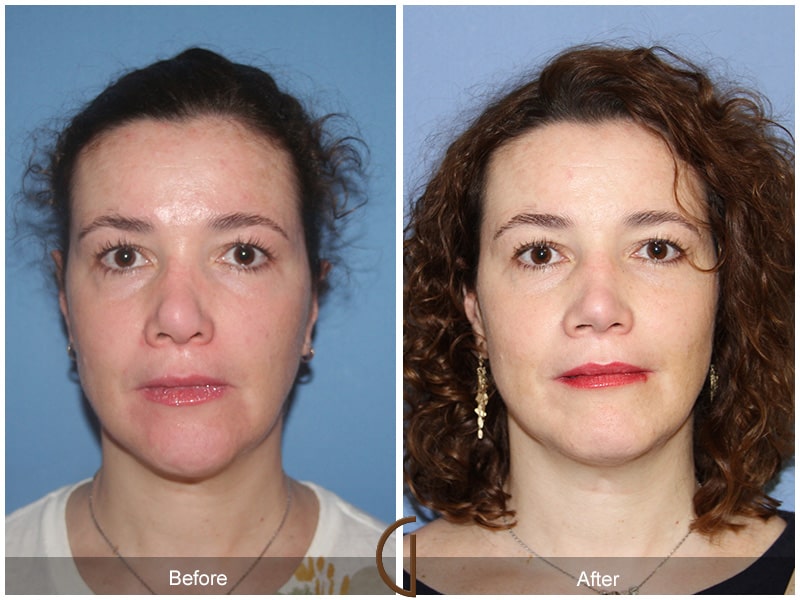 Rhinoplasty Las Flores CA 50 Image