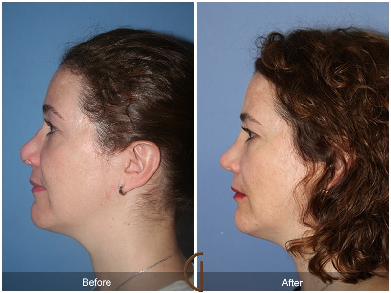 Rhinoplasty Las Flores CA 50 Image
