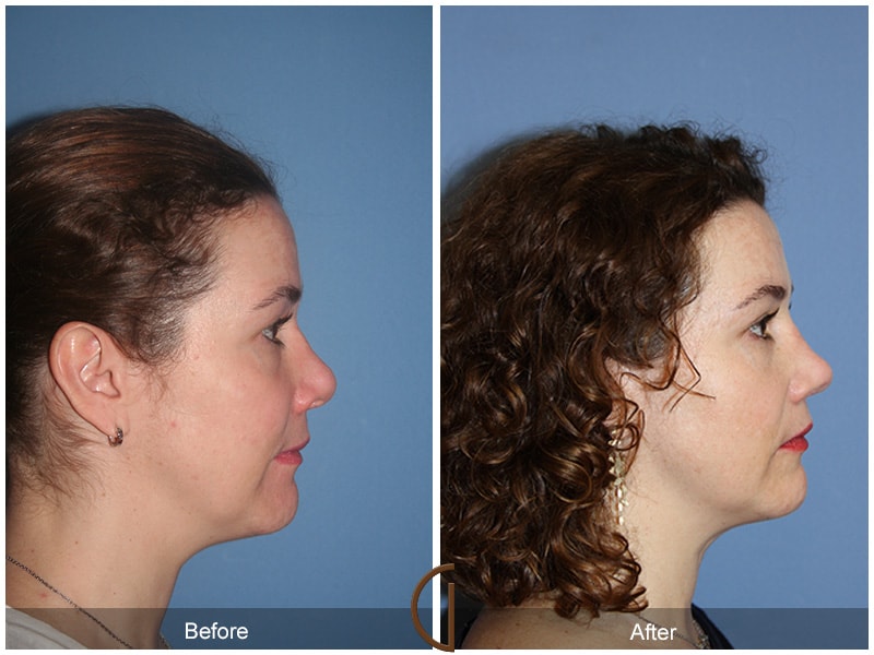 Rhinoplasty Las Flores CA 50 Image