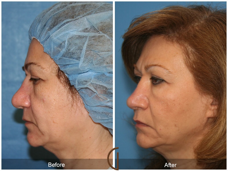 Rhinoplasty Yorba Linda CA 65 Image