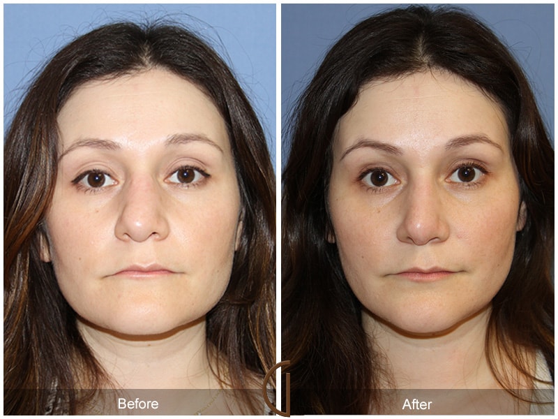 Rhinoplasty Newport Beach CA 74 Image