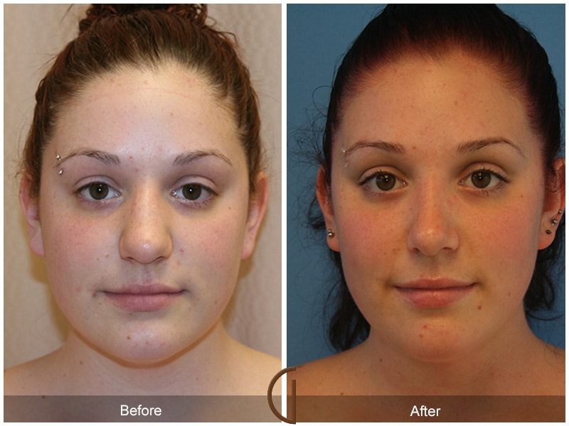 Rhinoplasty Nose Surgery Coto de Caza CA 10 Image