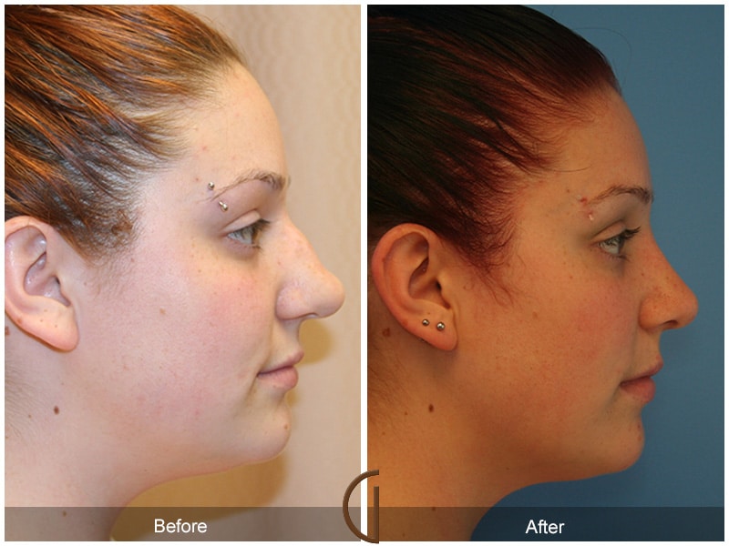 Rhinoplasty Nose Surgery Coto de Caza CA 10 Image