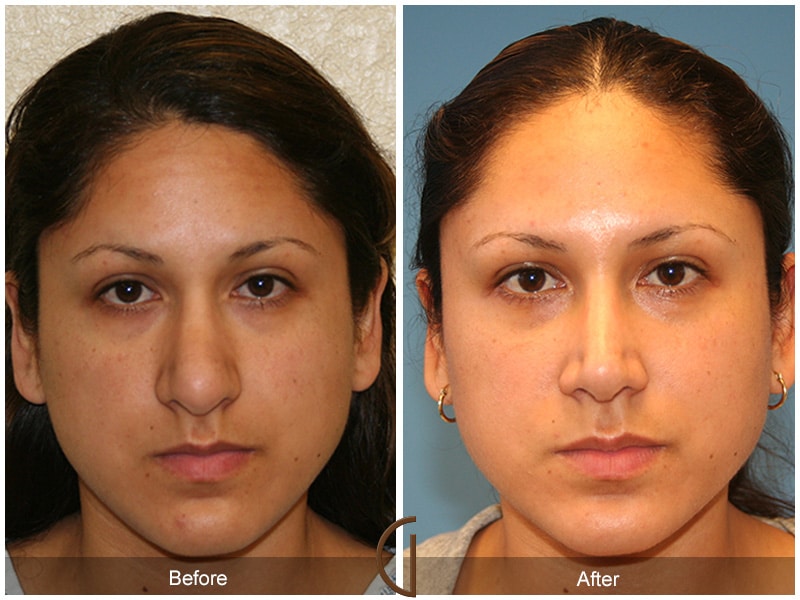 Rhinoplasty Nose Surgery Orange County CA 11 Image