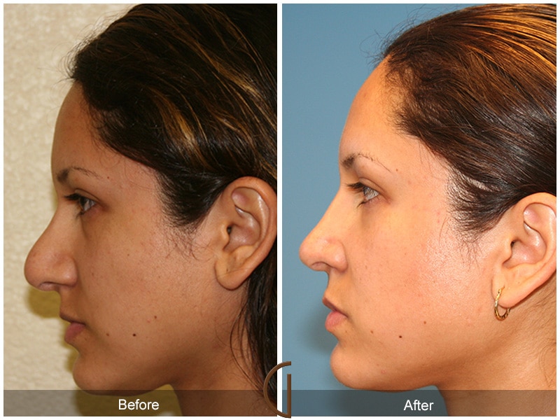 Rhinoplasty Nose Surgery Orange County CA 11 Image