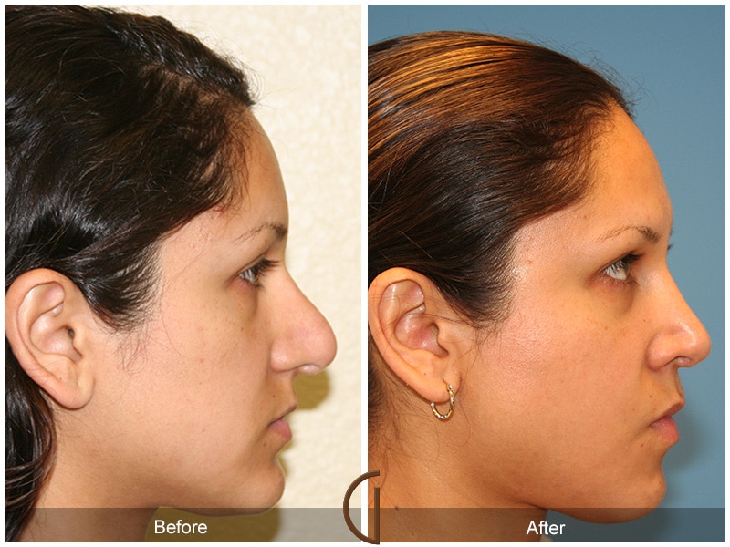 Rhinoplasty Nose Surgery Orange County CA 11 Image