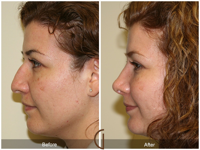 Rhinoplasty Nose Surgery Los Alamitos CA 12 Image