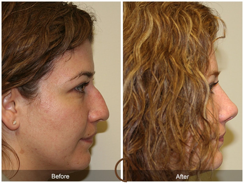Rhinoplasty Nose Surgery Los Alamitos CA 12 Image