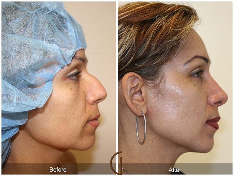 Rhinoplasty Nose Surgery Brea CA 13 Image