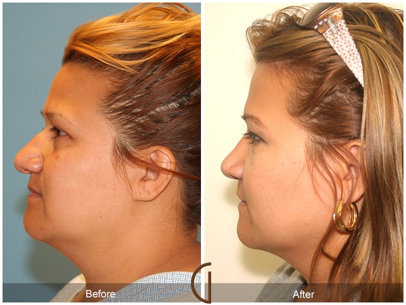 Rhinoplasty Nose Surgery Orange County CA 15 Image