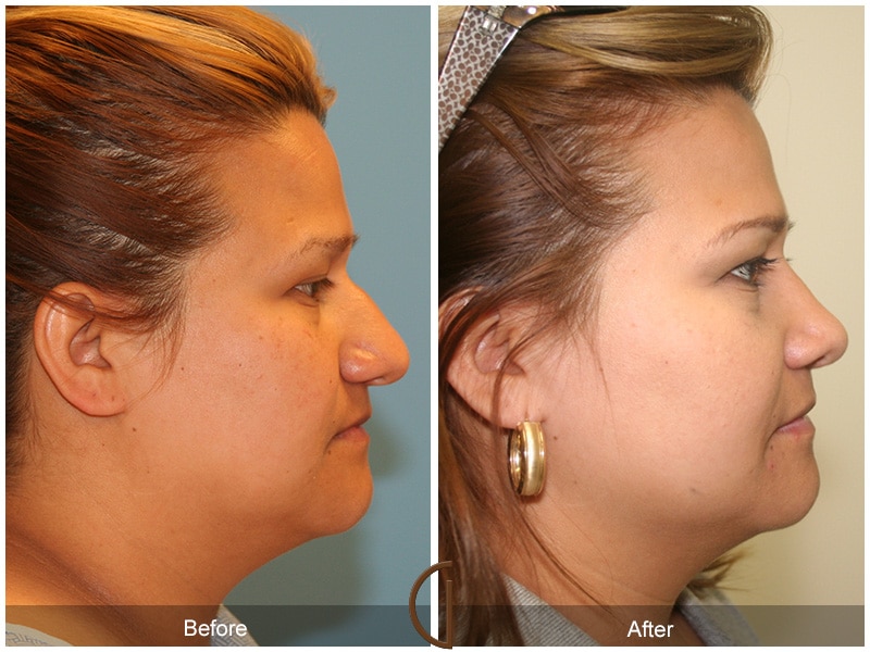 Rhinoplasty Nose Surgery Orange County CA 15 Image