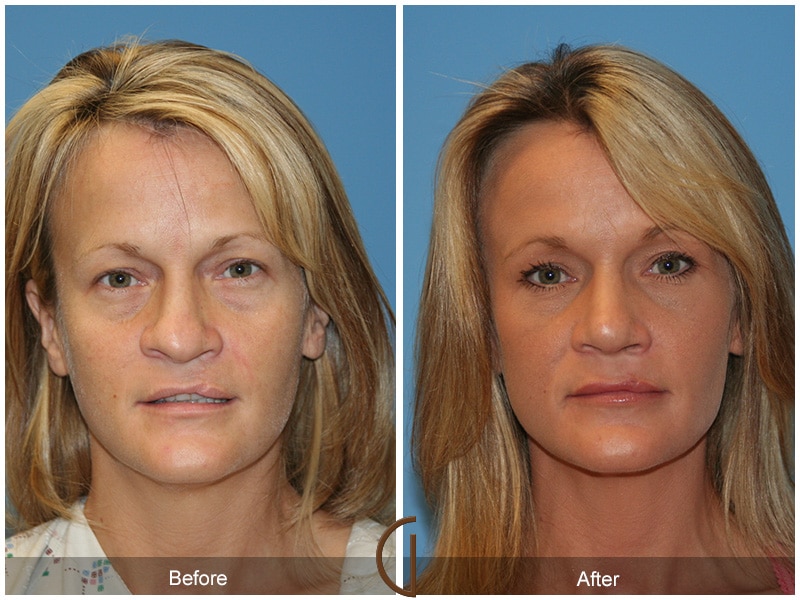 Rhinoplasty Nose Surgery Orange County CA 16 Image