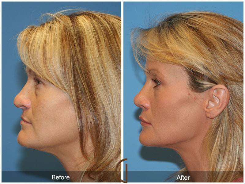 Rhinoplasty Nose Surgery Orange County CA 16 Image
